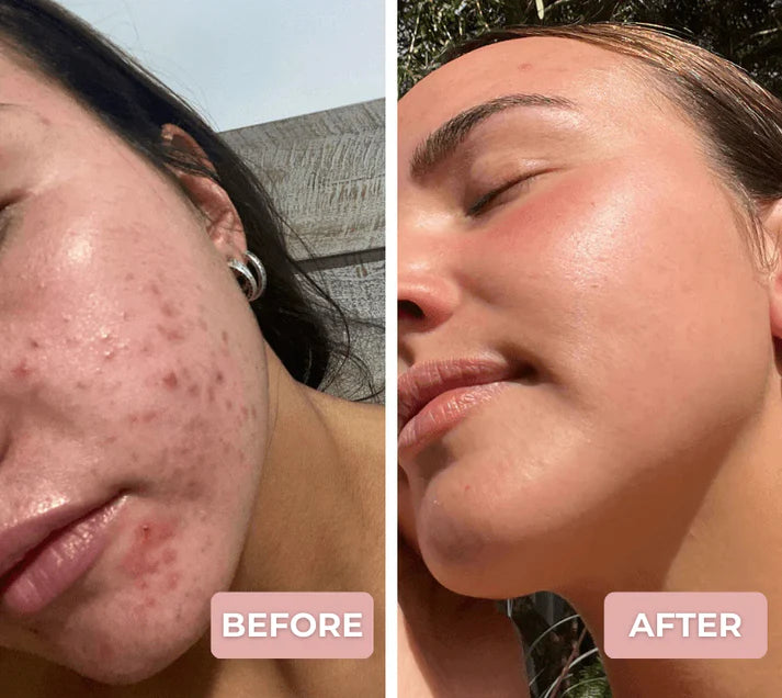 Lotus7 LED Therapy Mask